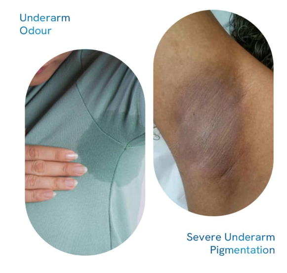 Be Bodywise Pigmentation Kit | With 4% AHA BHA Underarm Roll-On (50ml) & Pigmentation Repair Cream (100g) | Reduces Body Odor, Fades Pigmentation & Corrects Uneven Skin Tone - Image 2