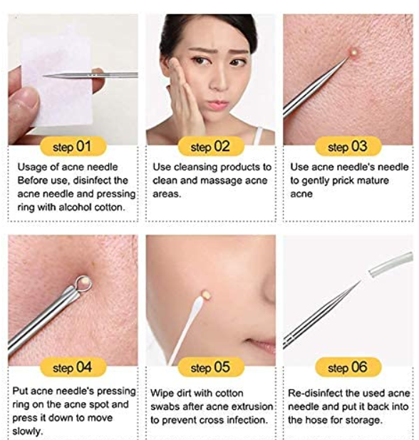 Angelie Stainless Steel Blackhead Remover & Pimple Blemish Remover Tool Set | 4-Piece Extractor Kit for Face, Nose, and Acne Treatment | - Image 2